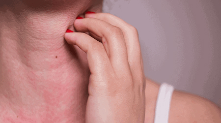 Аллергия у девушки